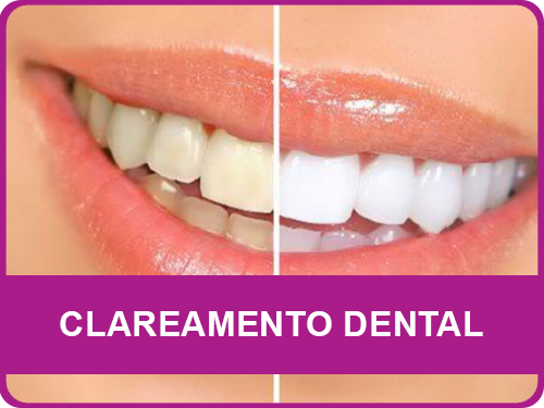 Clareamento Dental