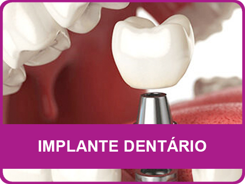 Implante Dentário